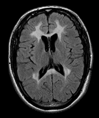 First Gene Therapy for Children with Metachromatic Leukodystrophy