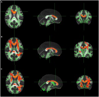 Diffusion tensor imaging (DTI) to locate epileptogenic abnormalities not detected by 3T MRI