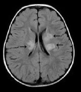 Early escalation of treatment reduces cognitive impairment and prevents decline in Childhood MS