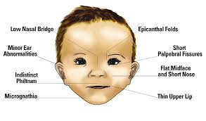 Screening for Fetal Alcohol Spectrum Disorder using Artificial Intelligence