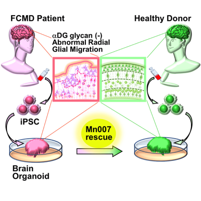 New treatment of Fukuyama congenital muscular dystrophy