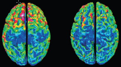 corticalthickness